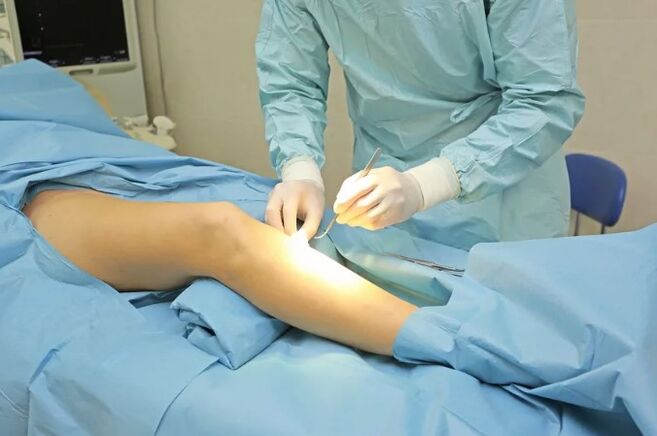 Fubletomy