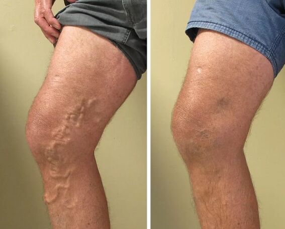 Varices veins before and after treatment