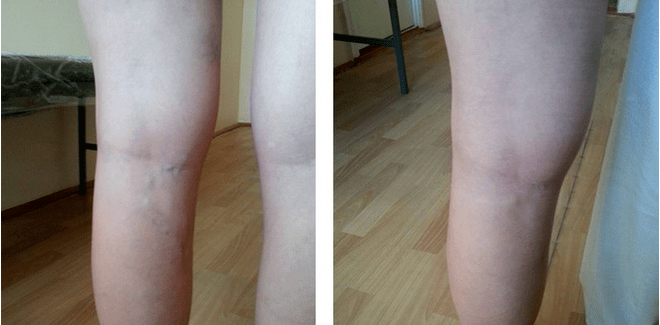Varices on the legs