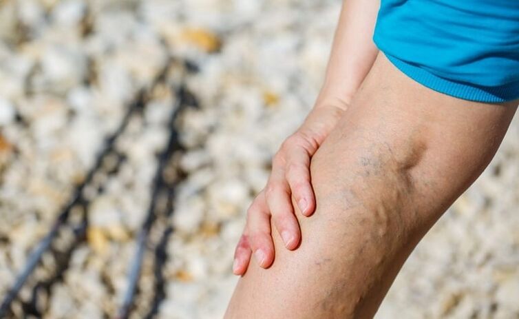 Varices on the leg